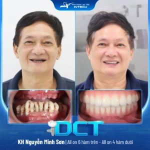 Patient Nguyen Minh Son - Full upper arch All-on-6 and full lower arch All-on-4 implant placement.