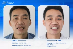 Patient Trinh Van Thap, received All-on-4 dental implants for both upper and lower jaws.