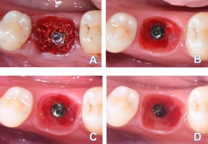 The alveolar socket and gingiva do not have a circular shape; rather, they are trapezoidal, parallelogram-shaped, or ovoid.