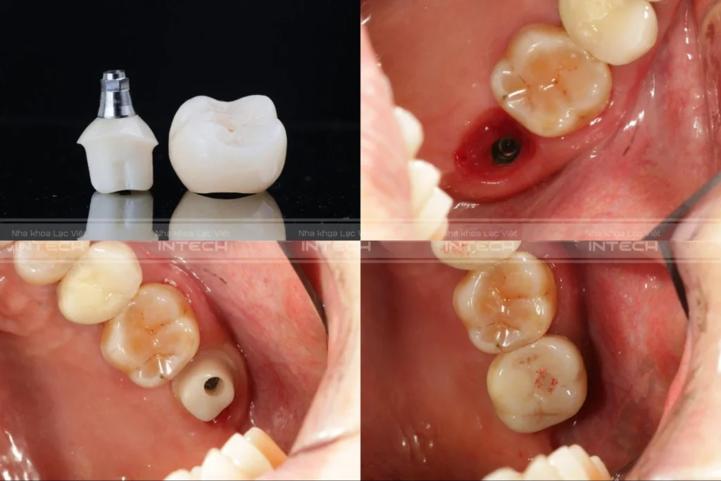 Image of a natural tooth preparation (stump), which has a trapezoidal shape similar to a standard gingival emergence profile. Only such a shape can aesthetically contour the gingiva and prevent food impaction.