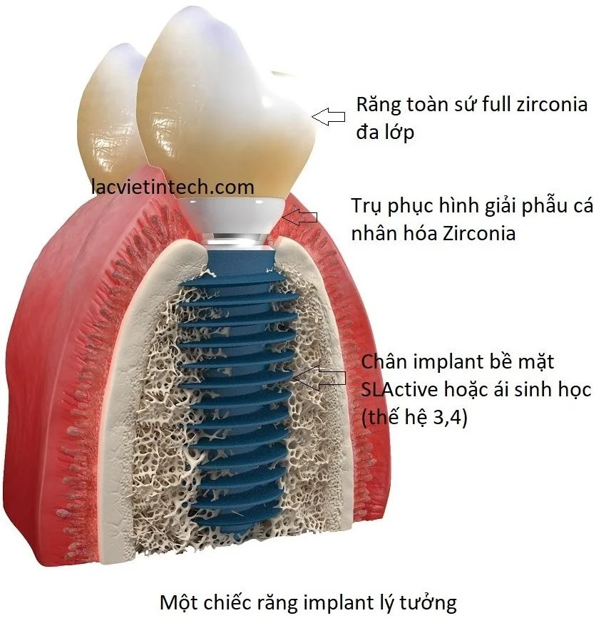 An ideal implant restoration consists of: A multilayer full zirconia ceramic crown , a zirconia customized anatomical abutment , and an implant fixture with an SLActive or hydrophilic surface.