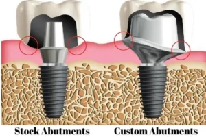Image of a prefabricated abutment and a zirconia customized anatomical abutment.