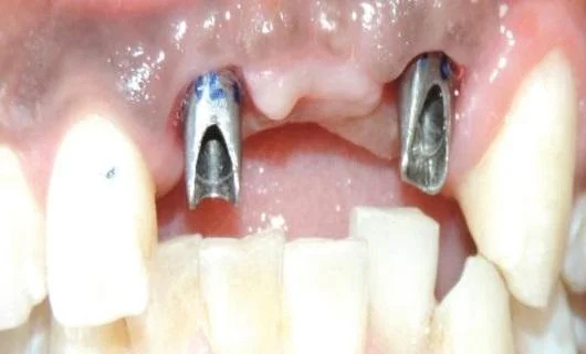 Stock Abutments are the classic type of abutment with the lowest cost.