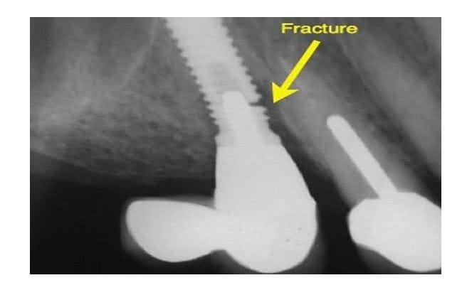 implant clinic in vietnam
